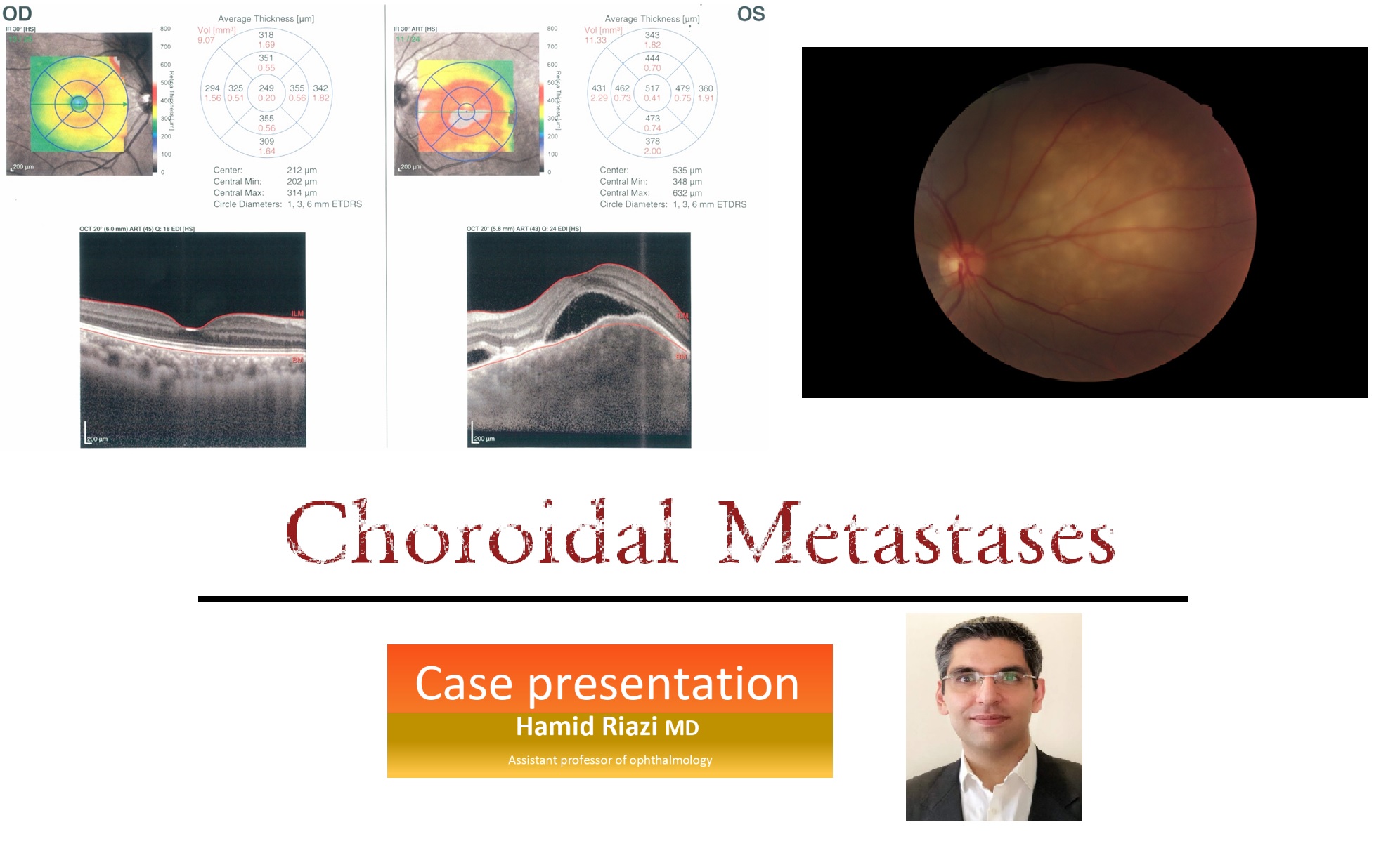 Choroidal Metastasis