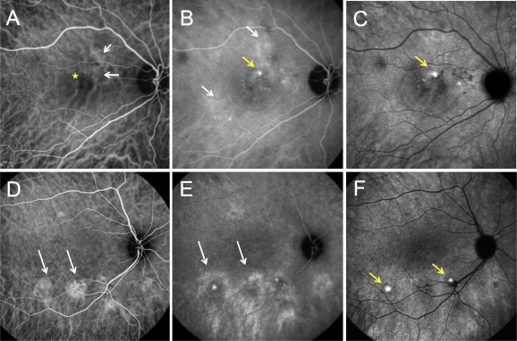 Photodynamic Therapy ( PDT ) in Central Serous Chorioretinopathy (CSC)