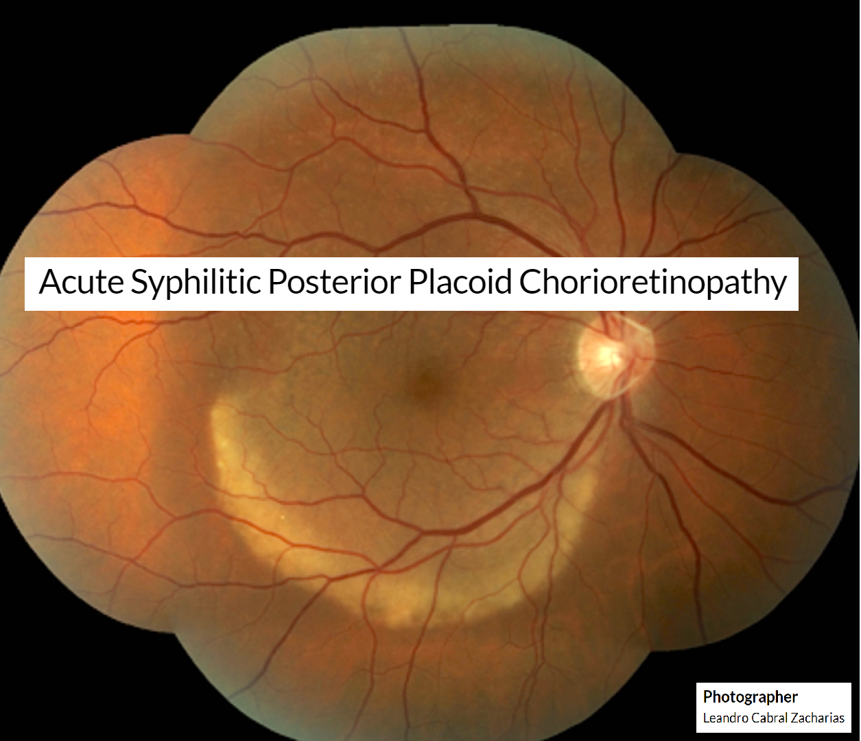 Acute Syphilitic Posterior Placoid Chorioretinopathy