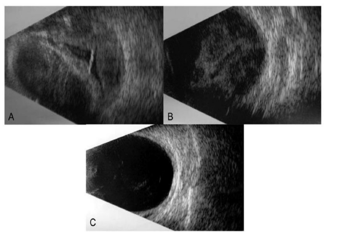 New Method for Management of Massive Suprachoroidal Hemorrhage