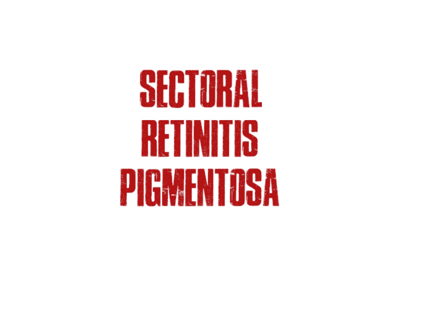 Sectoral Retinitis Pigmentosa