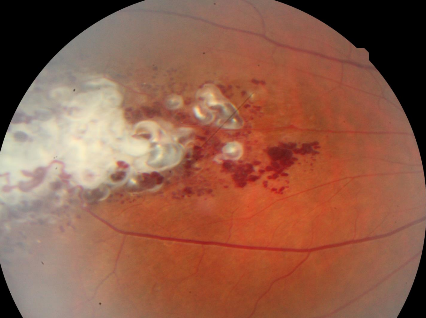 Retinal Cavernous Hemangioma
