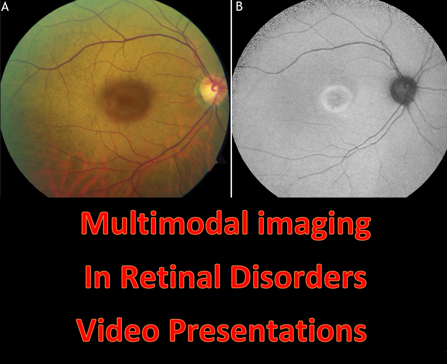Multimodal Imaging In Retinal Disorders