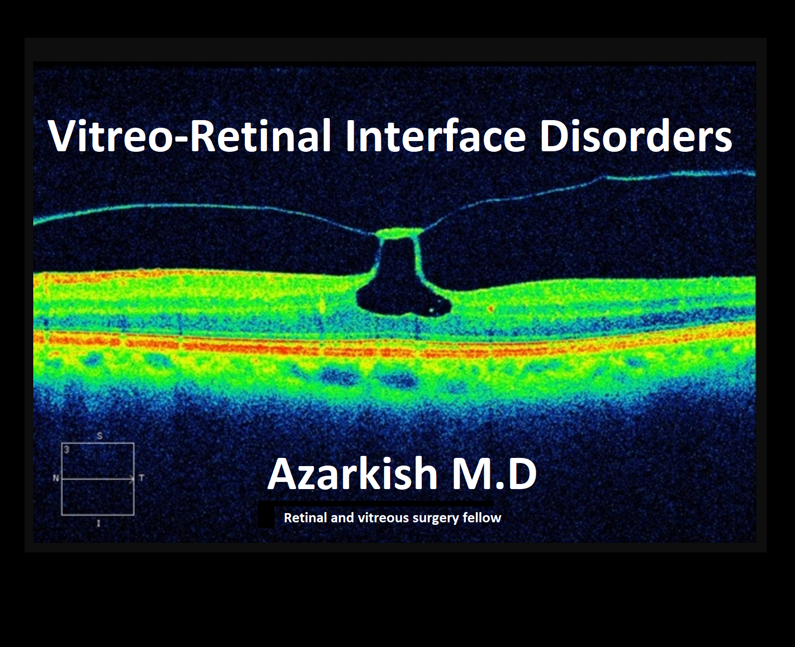 Vitreo-Retinal Interface Disorders