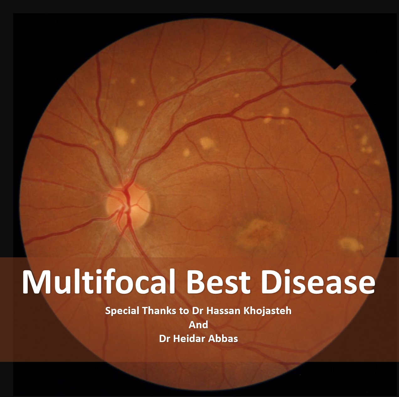 Multifocal Best disease (MBD)