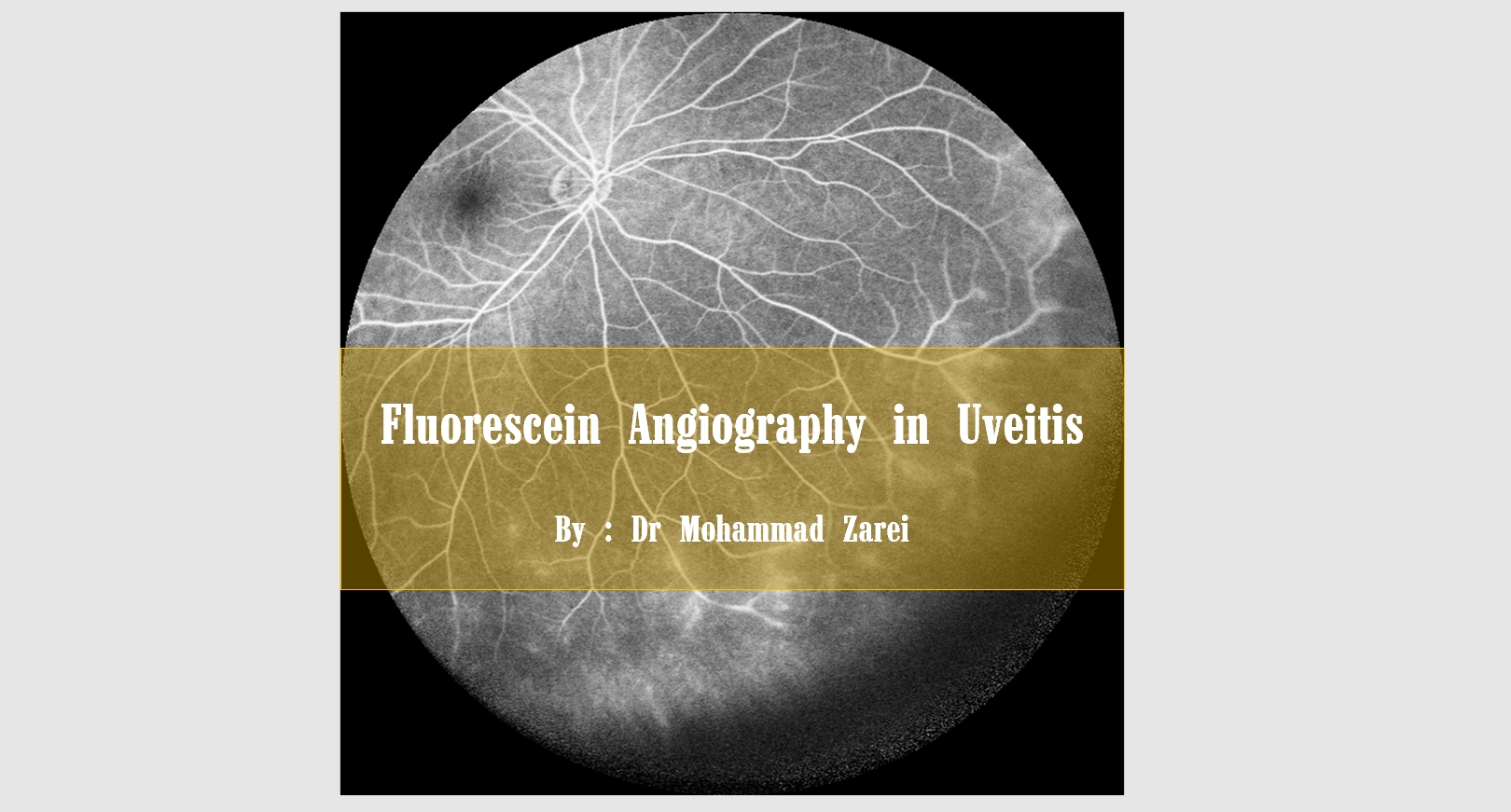 Fluorescein Angiography in Uveitis