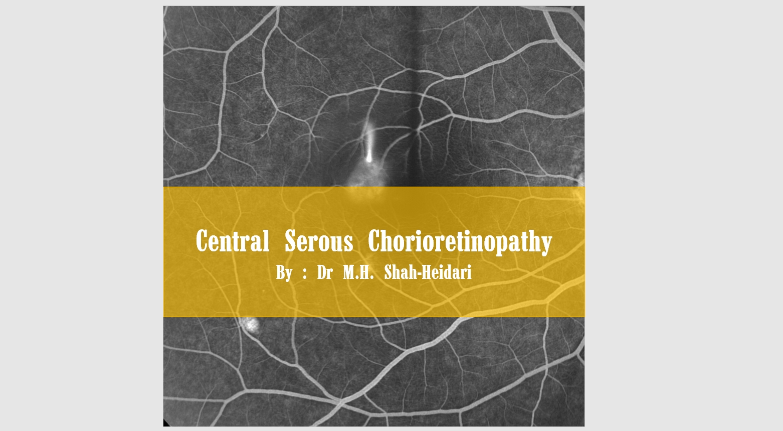 Central Serous Chorioretinopathy