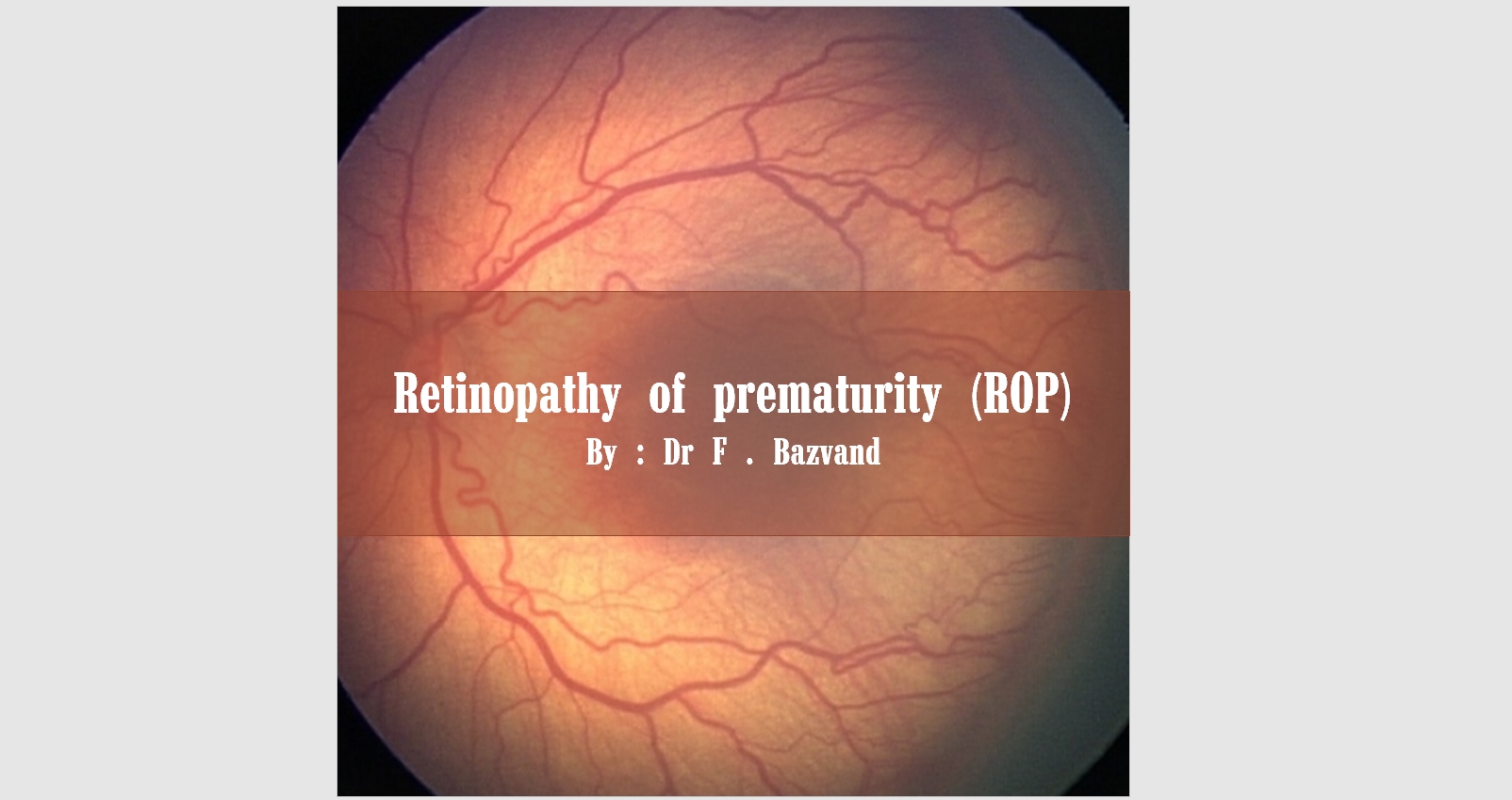Retinopathy of prematurity (ROP)