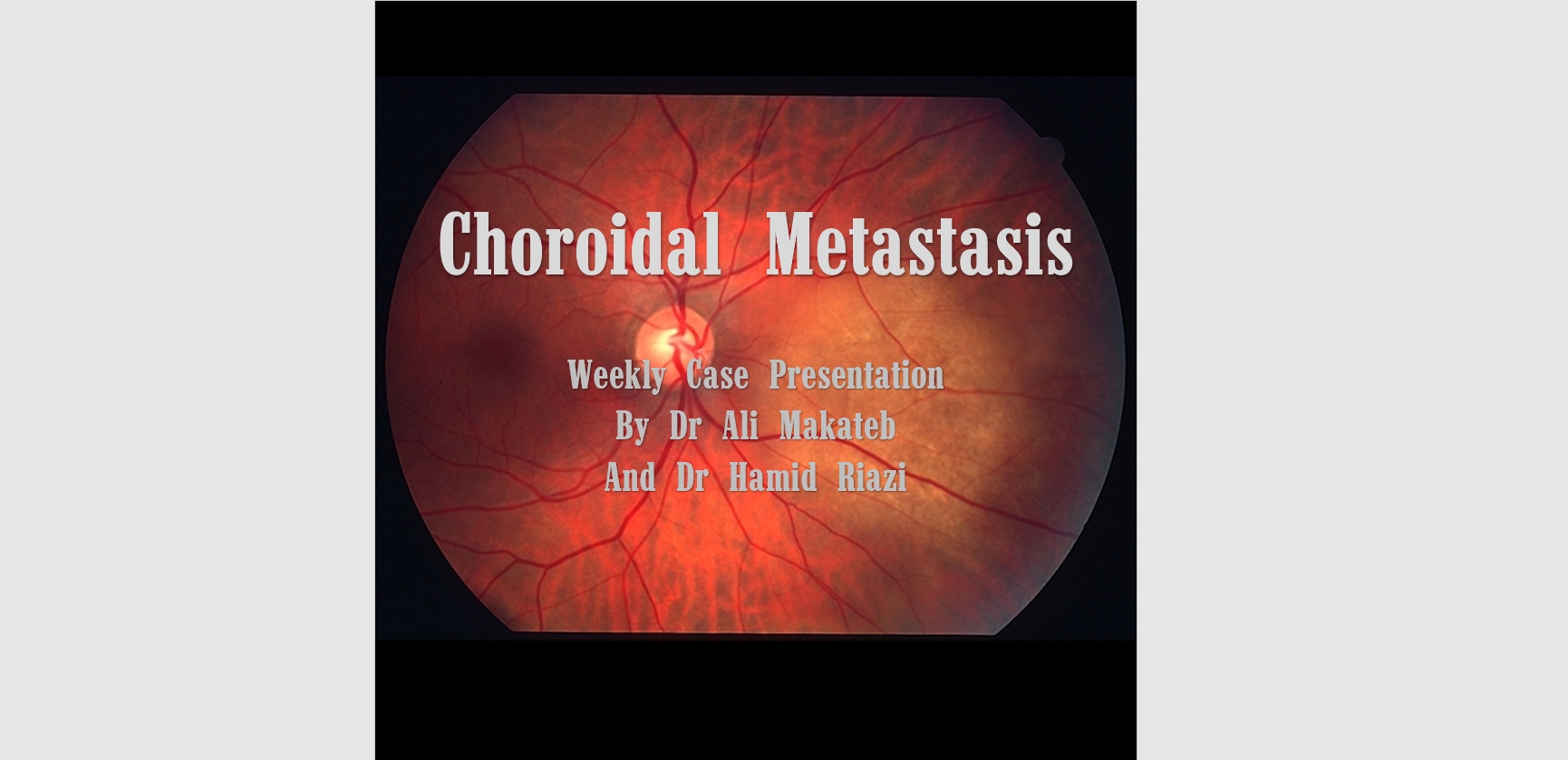 Choroidal Metastasis