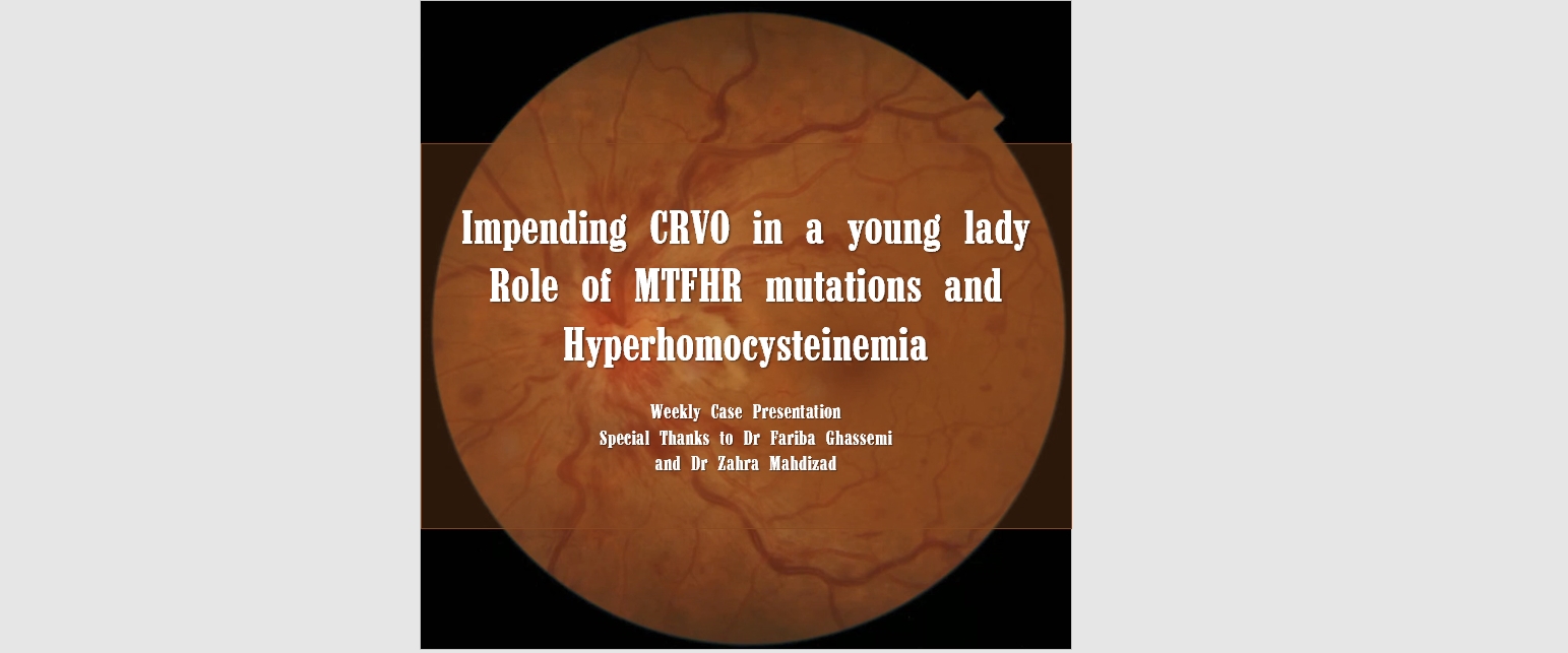 Impending CRVO in a young lady