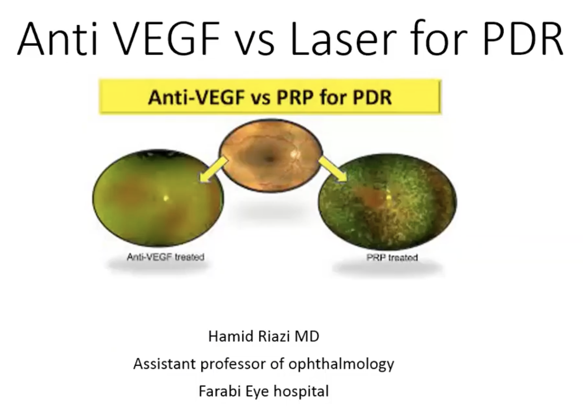 Anti VEGF vs. PRP in the Management of Proliferative Diabetic Retinopathy