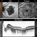 Geaographic Atrophy and Intravitreal Injections in Neovascular AMD