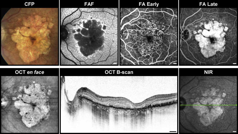 Geaographic Atrophy and Intravitreal Injections in Neovascular AMD