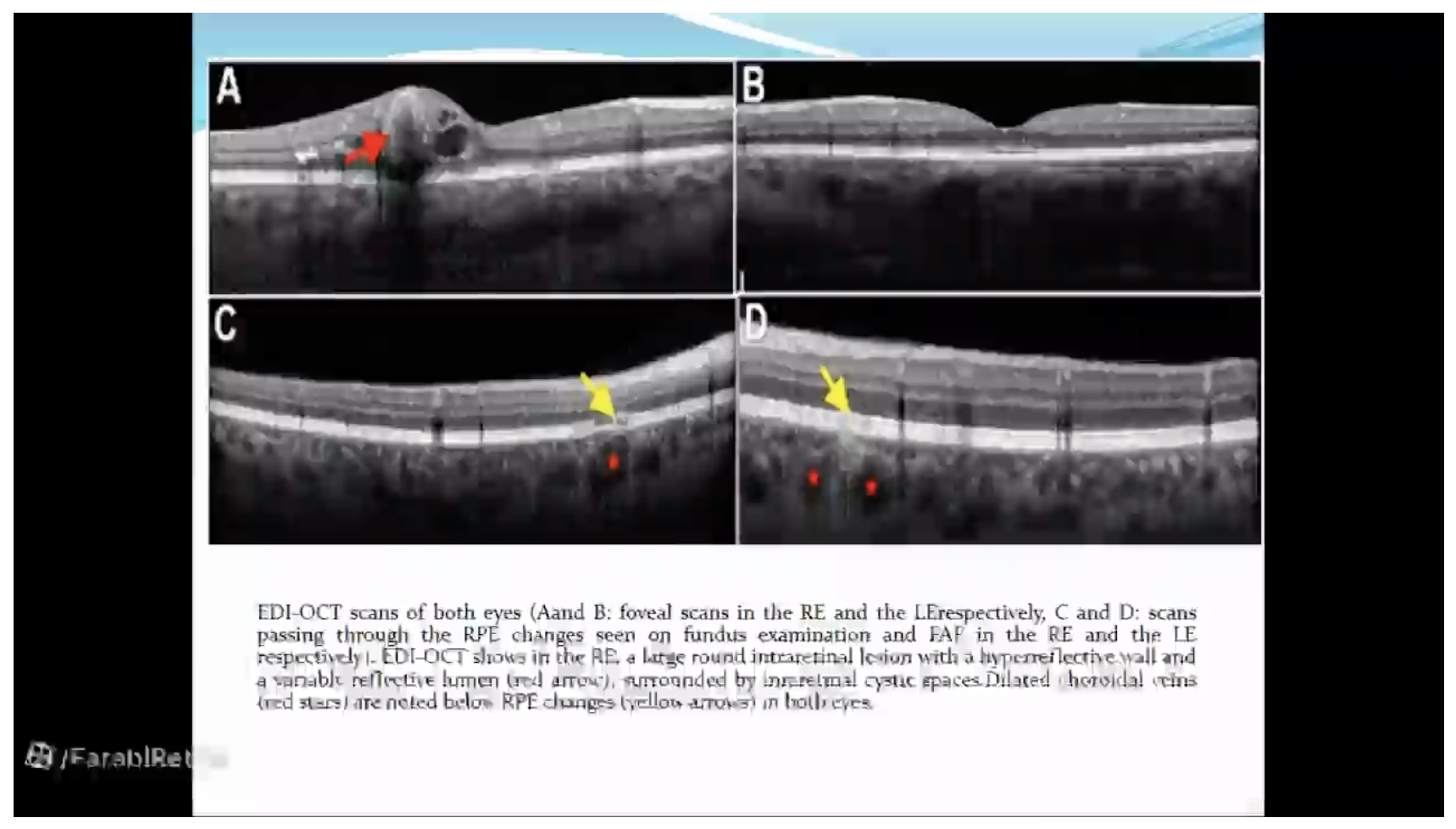 Journal Club 24-7-1401
