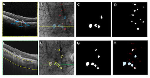 A Breakthrough in Diagnosing Early Macular Atrophy: Comparing OCT B-Scans and En Face Imaging