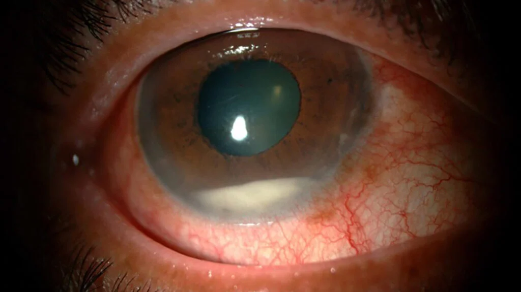 Pre-Operative Glycemic Control and Acute Endophthalmitis after Cataract Surgery