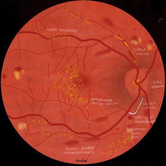 Hypertensive Retinopathy