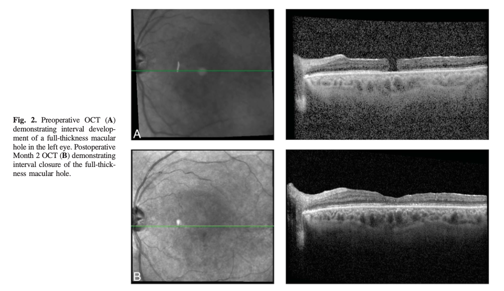 Macular Hole Surgery in Alport Syndrome: A Sticky Challenge