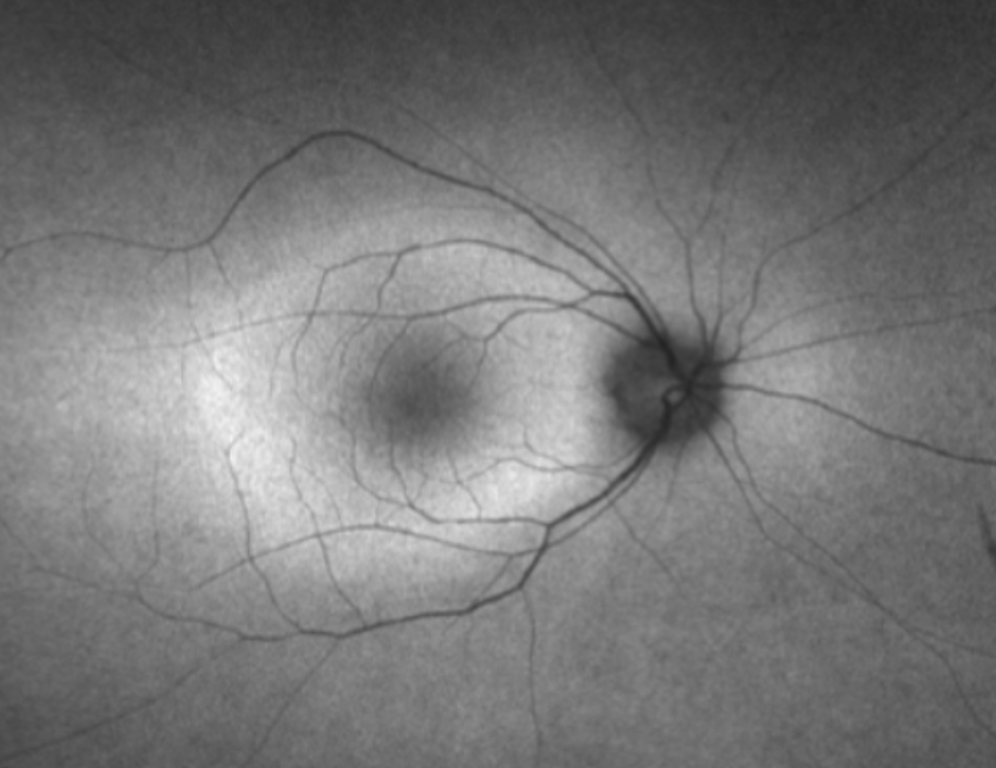 Guidelines for the Diagnosis, Management, and Study of Autoimmune Retinopathy (AIR)