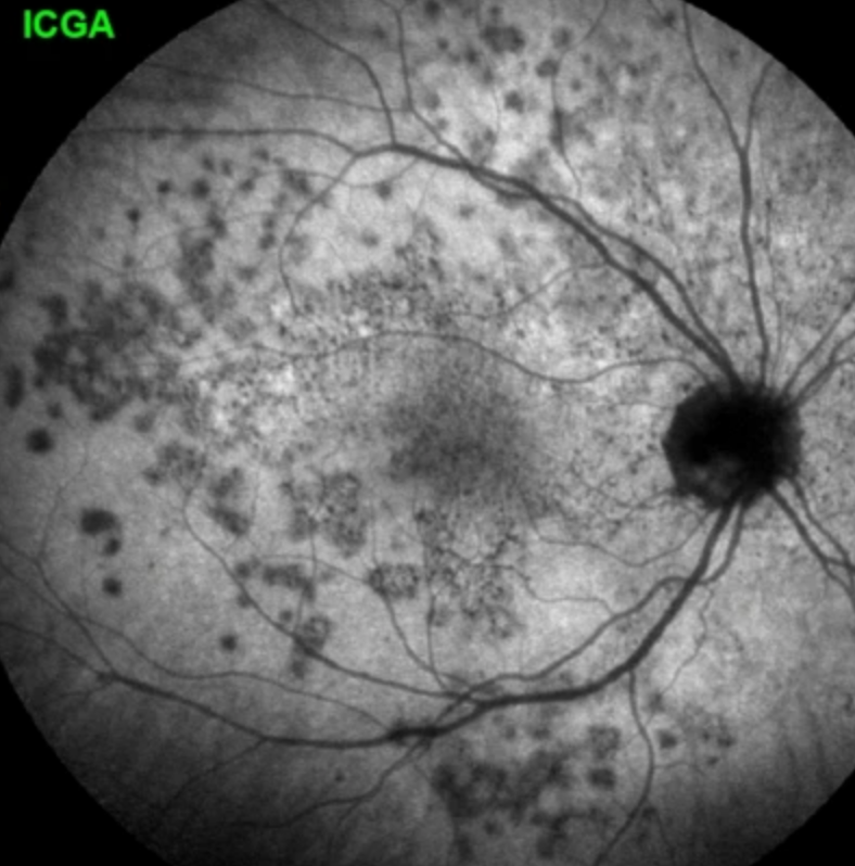 Choroidal Vasculitis and Indocyanine Green Angiography (ICGA)