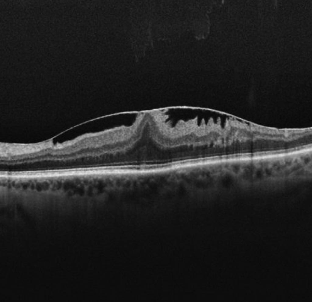 Updates on Epiretinal Membrane (ERM) Surgery