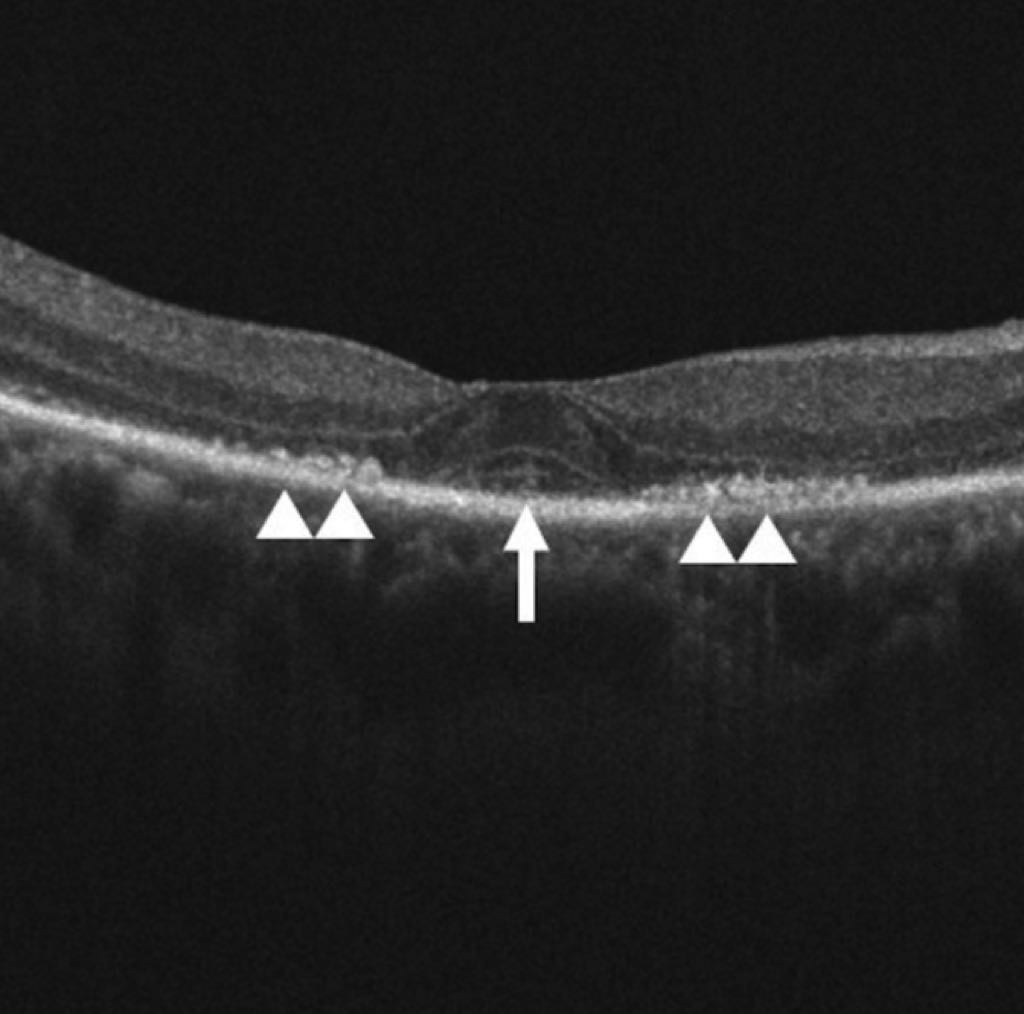 Risk Factors for HCQ Retinopathy