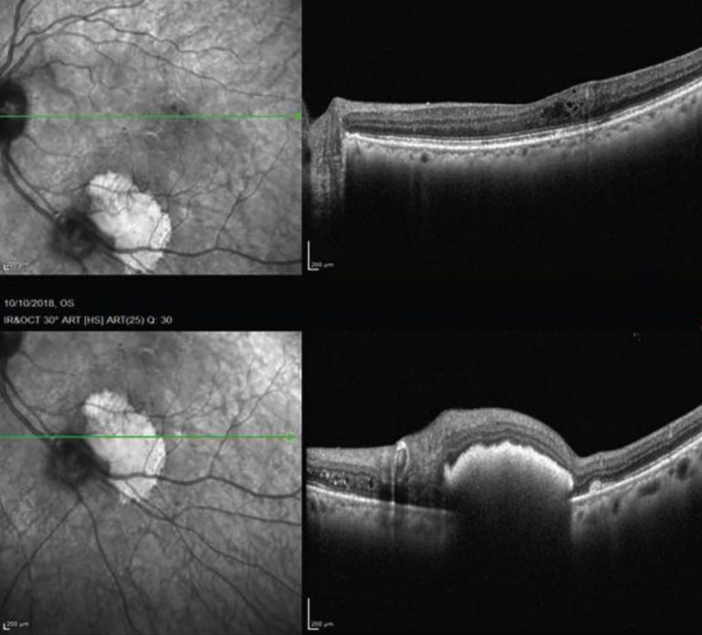 Retinal Arterial Macroaneurysm