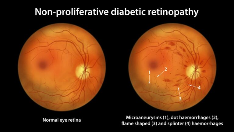 Risk of Progression of Non-Proliferative to Proliferative Diabetic Retinopathy Following Cataract Surgery