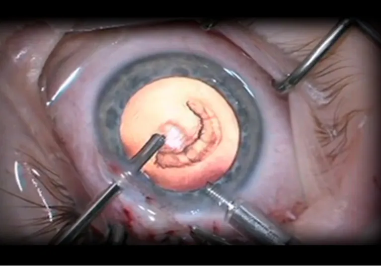 Factors Associated with Retinal Detachment Following Pediatric Cataract Surgery in the IRIS® Registry