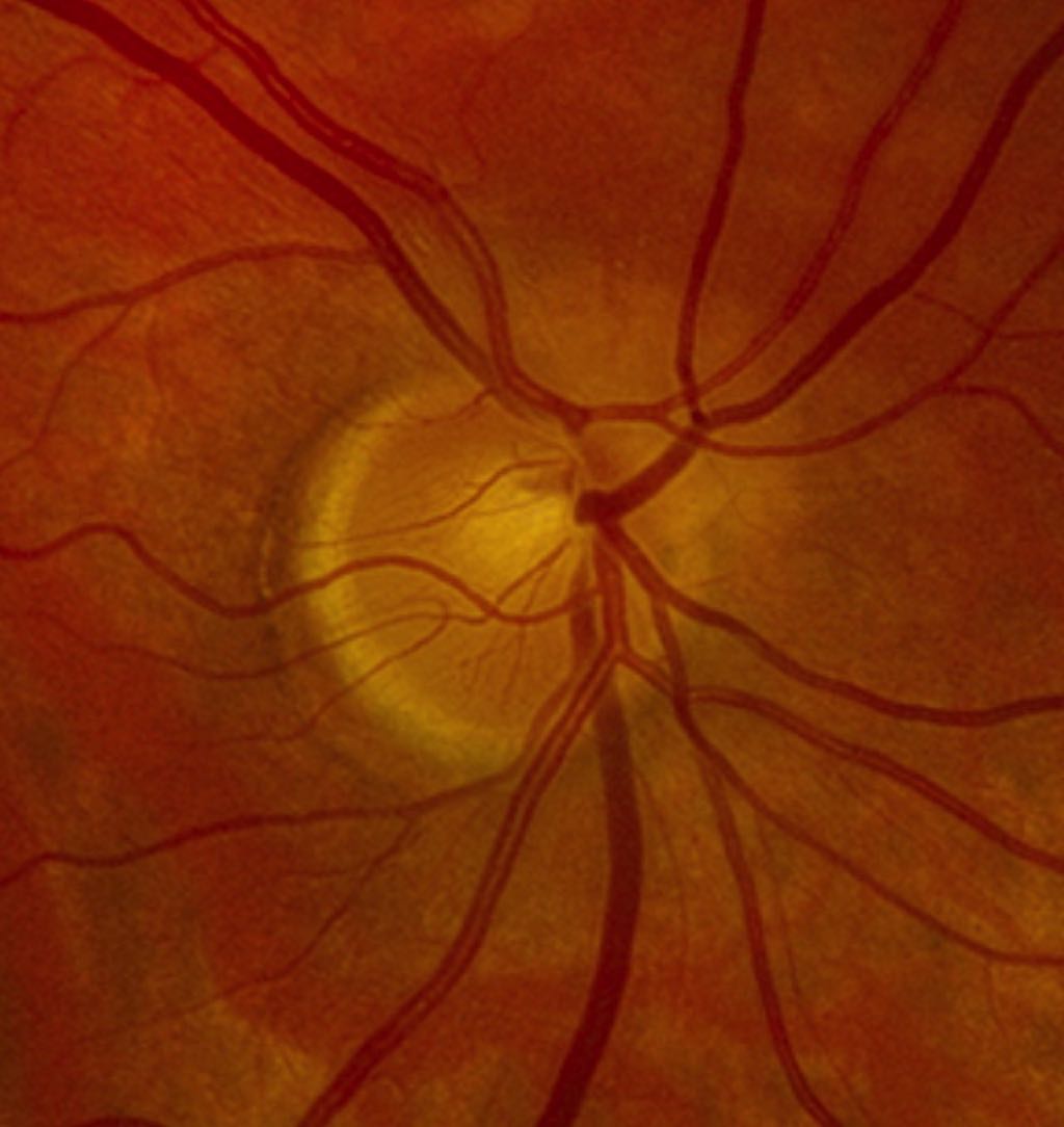 Segmental Optic Nerve Hypoplasia