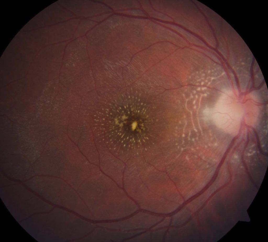 Neuroretinitis: A Comprehensive Review