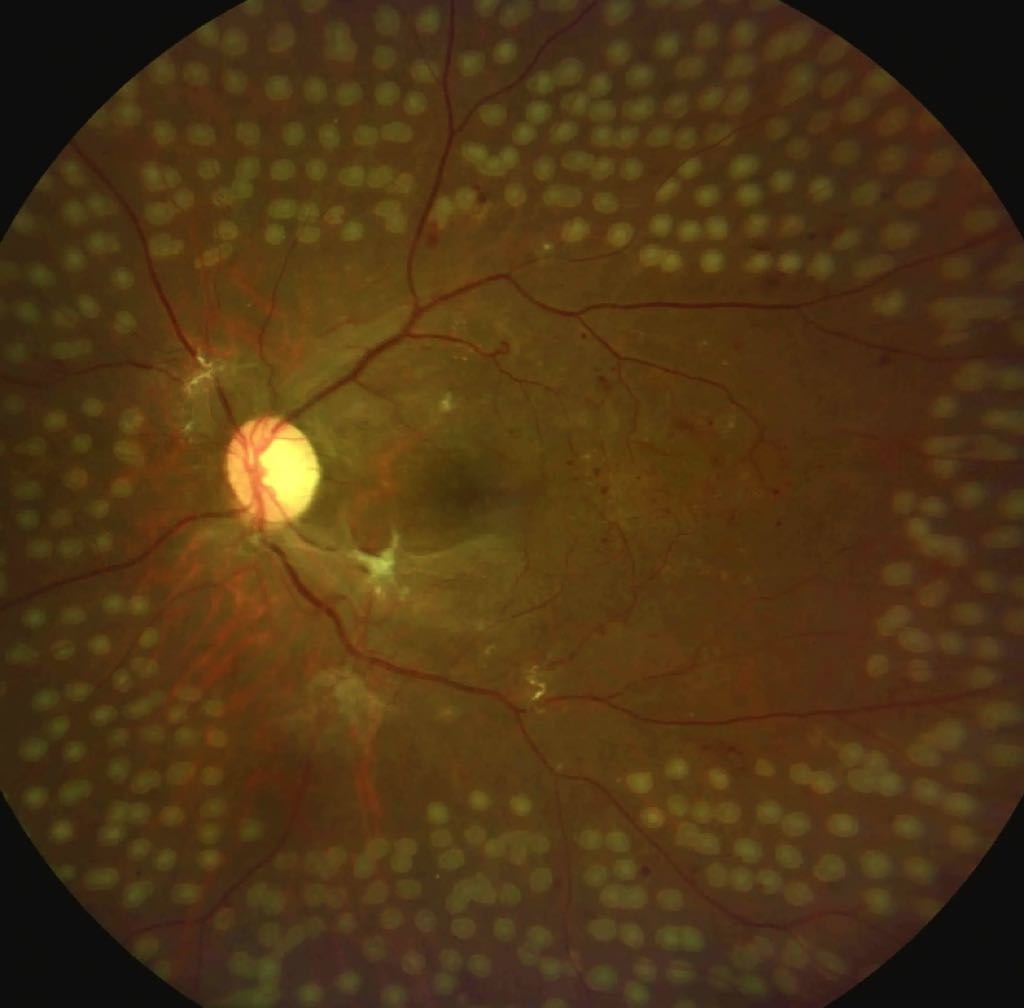 Shifting Tides in Diabetic Retinopathy Treatment: The Rise of Ranibizumab and Decline of Panretinal Photocoagulation Post-Protocol S