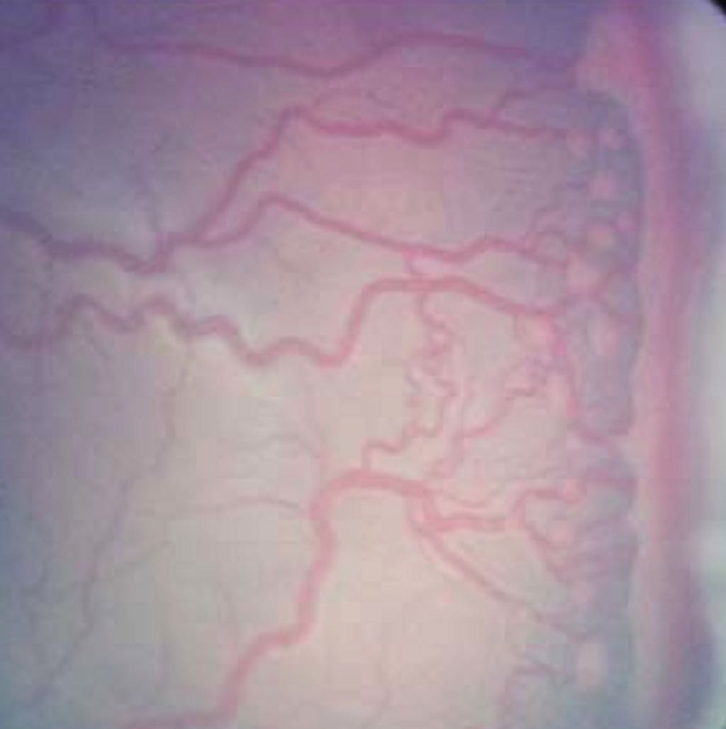 Unveiling the Hidden Risks of ROP: How Isolated Retinal Neovascularization Signals Severe Disease Progression in Premature Infants
