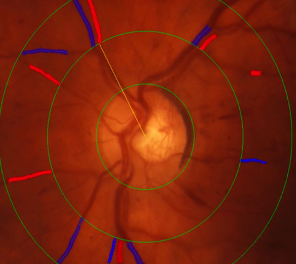 Anti-VEGF Therapy vs. Panretinal Photocoagulation: Long-Term Impact on Retinal Vessel Caliber in Proliferative Diabetic Retinopathy