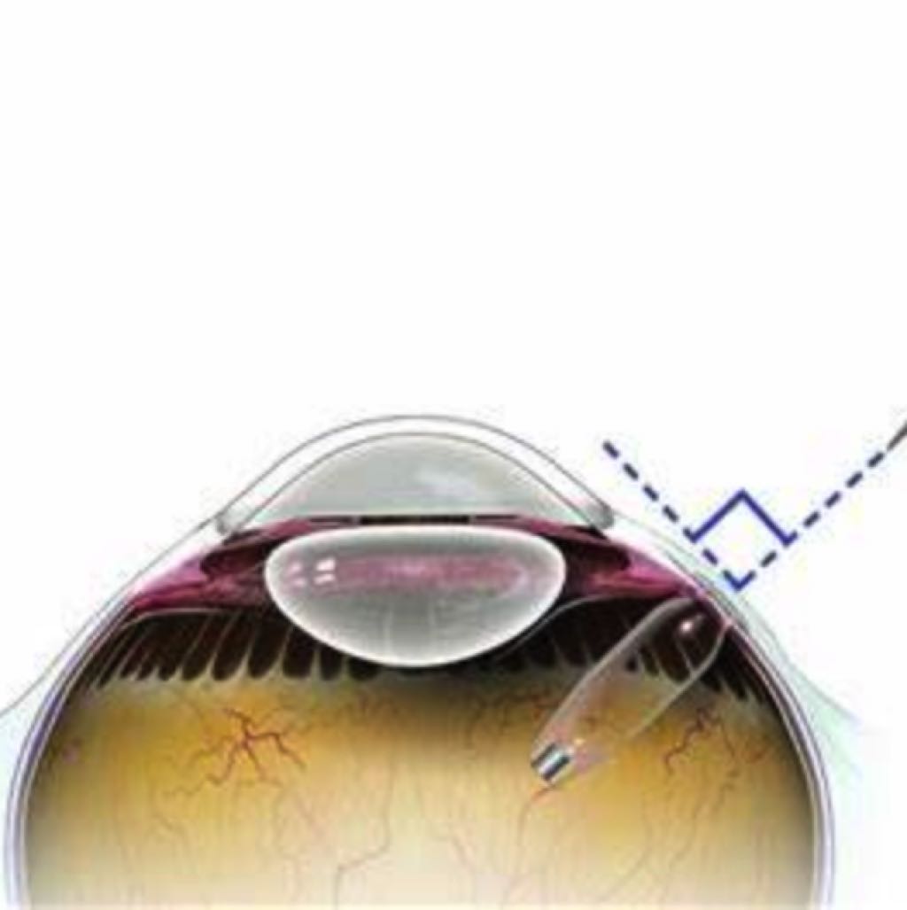 Port Delivery System with Ranibizumab Outperforms Monitoring in Preventing Progression of Nonproliferative Diabetic Retinopathy: Pavilion Trial Results