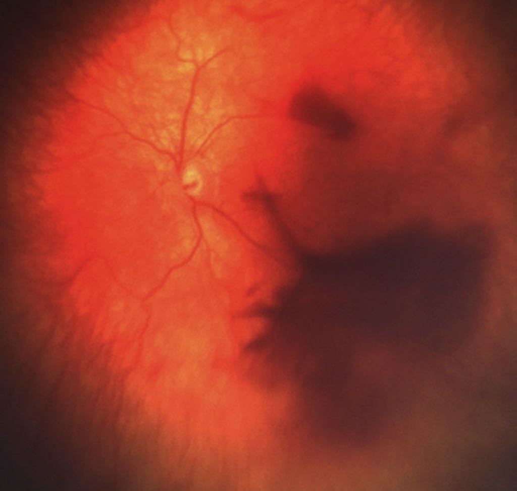 Genetic Overlap Uncovered: Atypical ROP May Mask FEVR or TBD, Urging Genetic Testing for Accurate Diagnosis