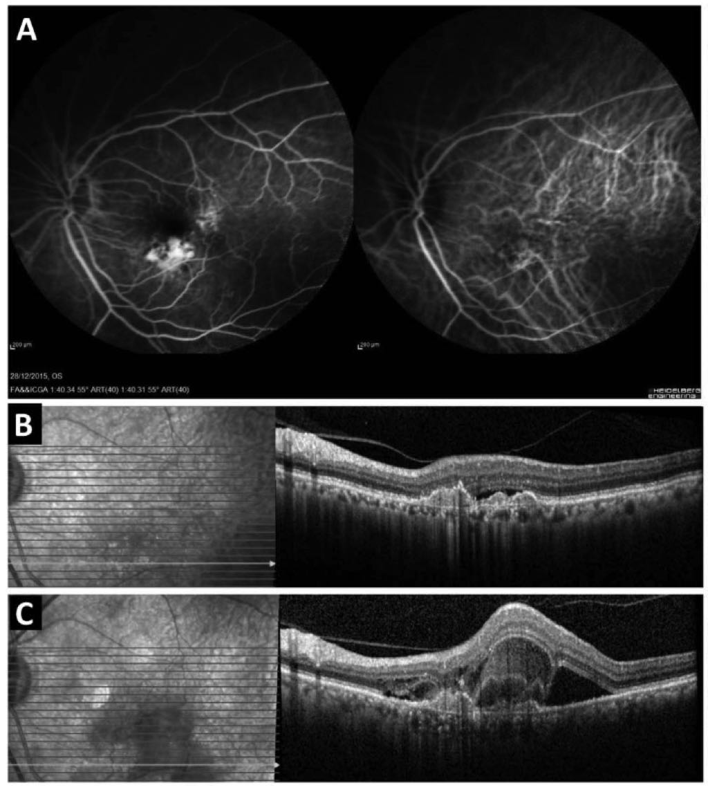 Navigating the Challenges of Photodynamic Therapy: Understanding and Managing Acute Exudative Maculopathy