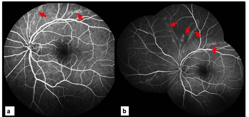 Protected: West Nile Virus (WNV) & Ocular Involvement