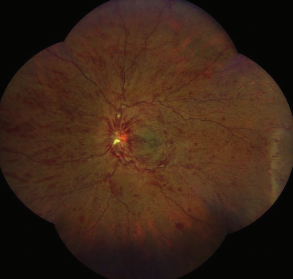 Clinical Trials for Retinal Vein Occlusion